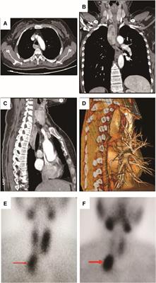 Case Report: Primary Hyperparathyroidism due to Posterior Mediastinal Parathyroid Adenoma With One-Year Follow-Up